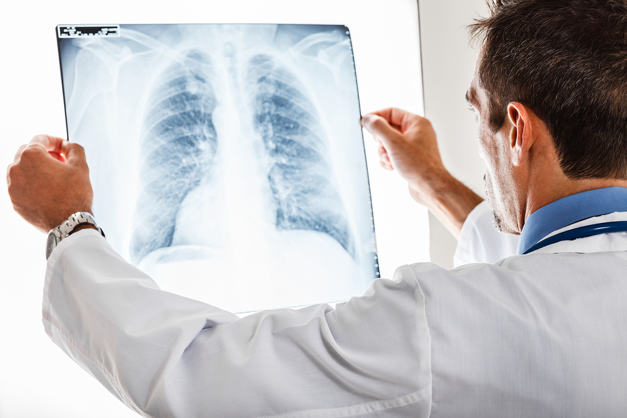 Doctor examining a lung radiography