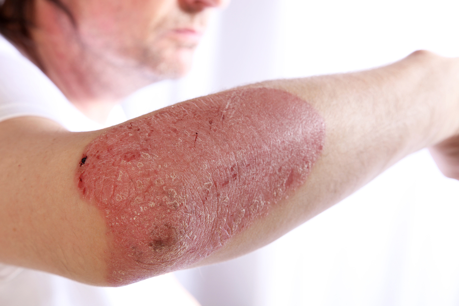 Person with plaque psoriasis of the arm causing an inflamed red patch of skin covered in silvery scales to extend from the elbow a chronic lifelong disease that is incurable but non-contagious Person with plaque psoriasis of the arm causing an inflamed red patch of skin covered in silvery scales to extend from the elbow a chronic lifelong disease that is incurable but non-contagious