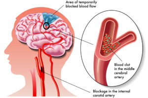 medical illustration of the effects of the TIA (transient ischemic attack) medical illustration of the effects of the TIA (transient ischemic attack)