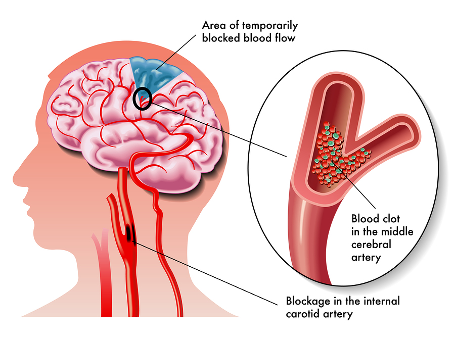 How to Apply for Disability Benefits in Pennsylvania after a Stroke Stroke Diagram - How to Apply for Disability Benefits in Pennsylvania after a Stroke